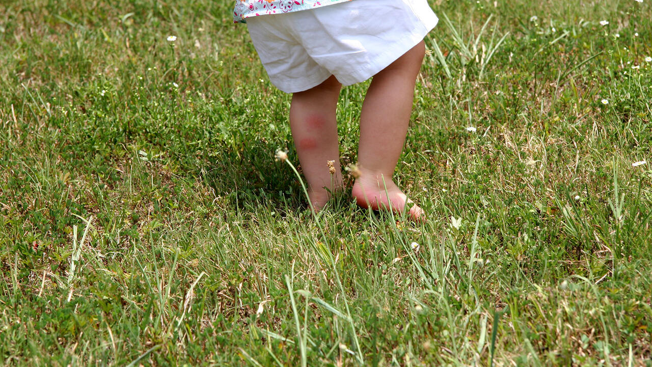A small child runs barefoot through tall grass and has red insect bites on his calf. 