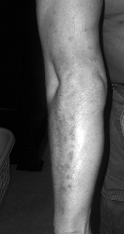 A person's arm with small, red spots.