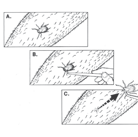 To remove a tick, grab it at the head with blunt forceps/tweezers, and pull straight back and out of the skin.
